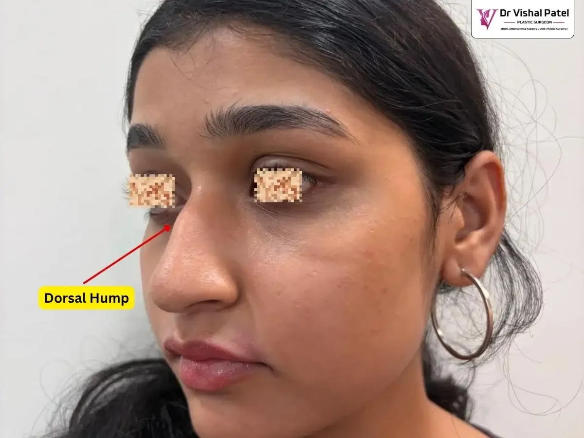 Non surgical rhinoplasty before photo in Mumbai