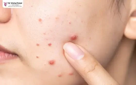 Finger pointing to Facial acne.