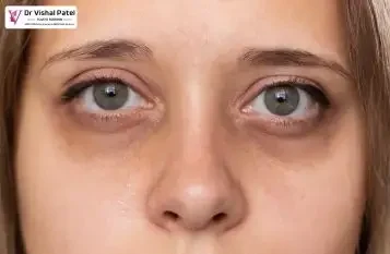Women face with dark circles.