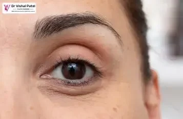 PRP treatment for under eye bags in Mumbai