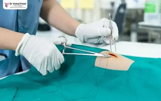 Skin is being stitched with fine suture.