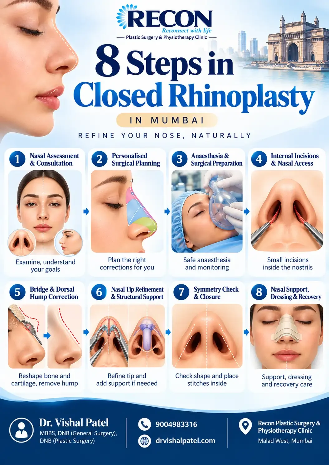 Infographics mentioning Steps of Closed Rhinoplasty in India.