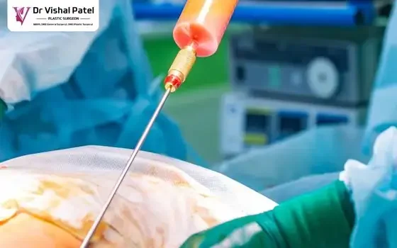 Suction Thigh Liposuction in Mumbai by Dr. Vishal Patel Suction Thigh Liposuction in Mumbai by Dr. Vishal Patel