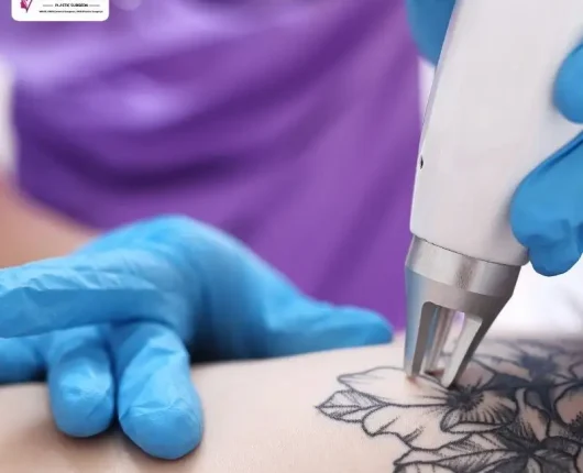 Tattoo removal machine.