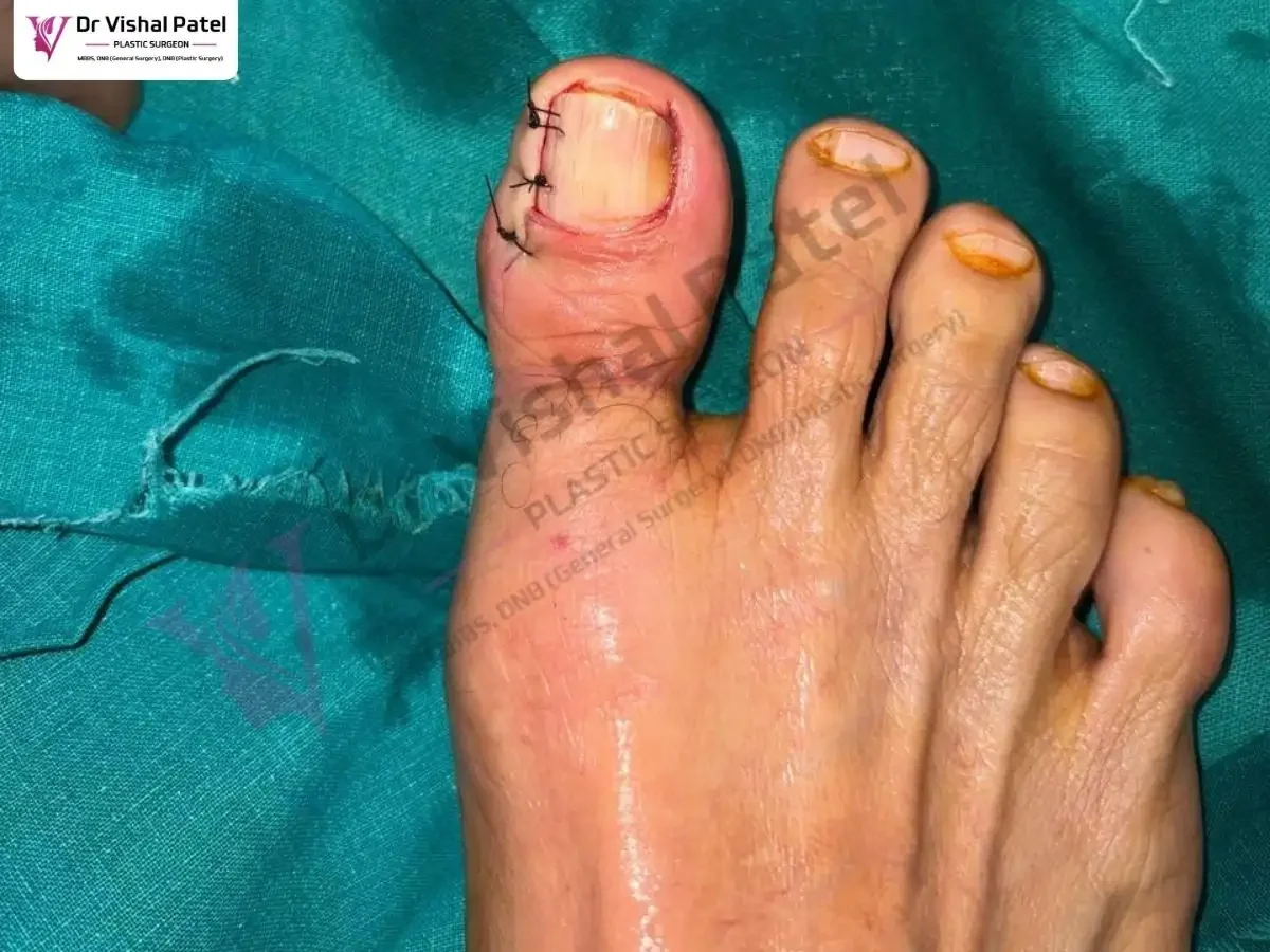 Toenail after surgery with stiches.