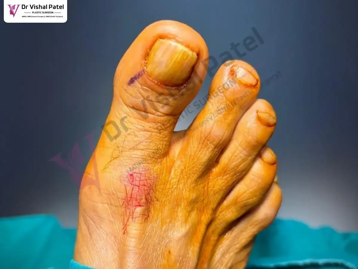 Toenail with marking of infected area.