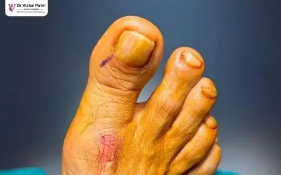 Toenail Treatment in Mumbai on 19-2-2026 by Dr. Vishal Patel
