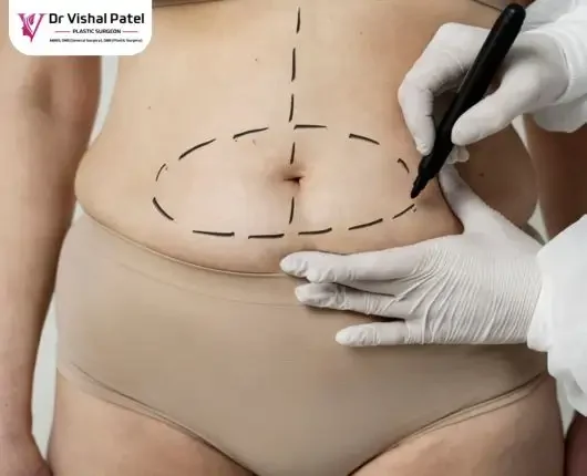 Tummy Tuck Surgery in Mumbai