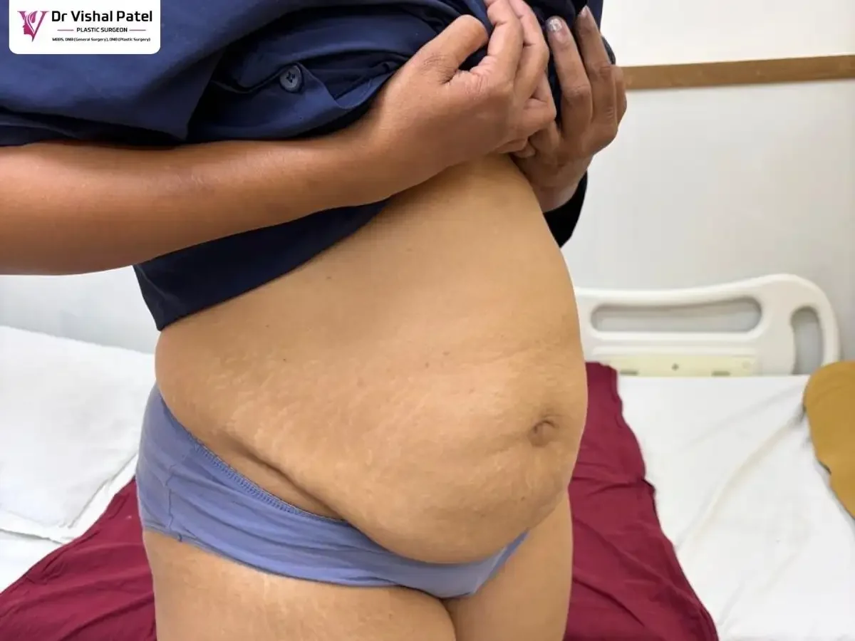 Female patient belly with heavy sagging.