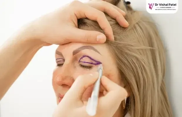 Upper lid blepharoplasty cost in Mumbai - Dr Vishal Patel