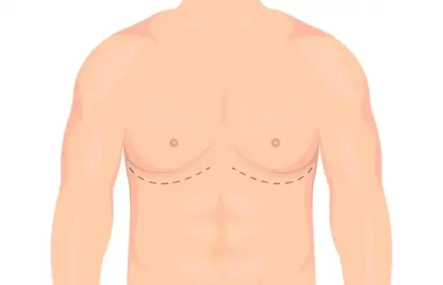 Various Gynecomastia Stages