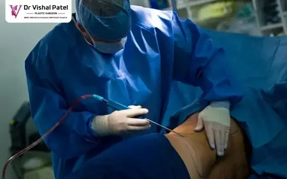 Vaser Tummy Liposuction in Mumbai by Dr. Vishal Patel Vaser Tummy Liposuction in Mumbai by Dr. Vishal Patel