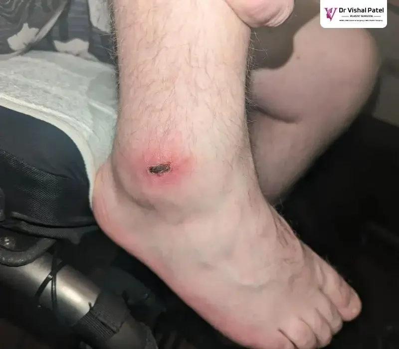 A leg with bed sore infection.