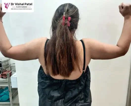 What is Arm Liposuction in Mumbai _ Dr Vishal Patel Explains What is Arm Liposuction in Mumbai _ Dr Vishal Patel Explains