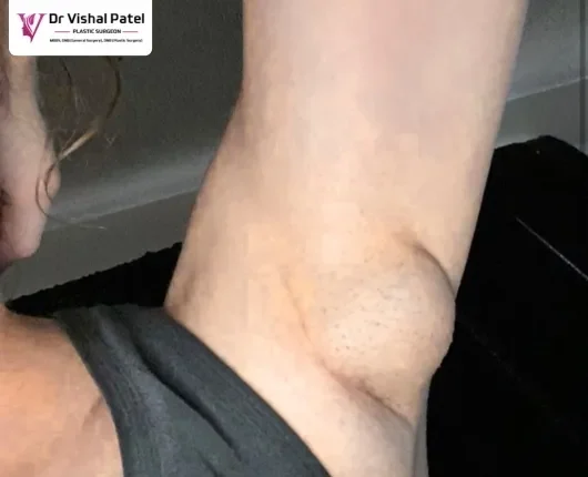 What is Axillary breast tissue _ Dr. Vishal Patel Explains