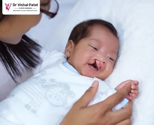 Lady holding baby with cleft lip in Mumbai.