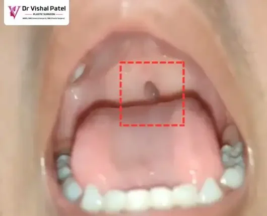 Mouth internal view of boy with cleft palate problem in Mumbai.