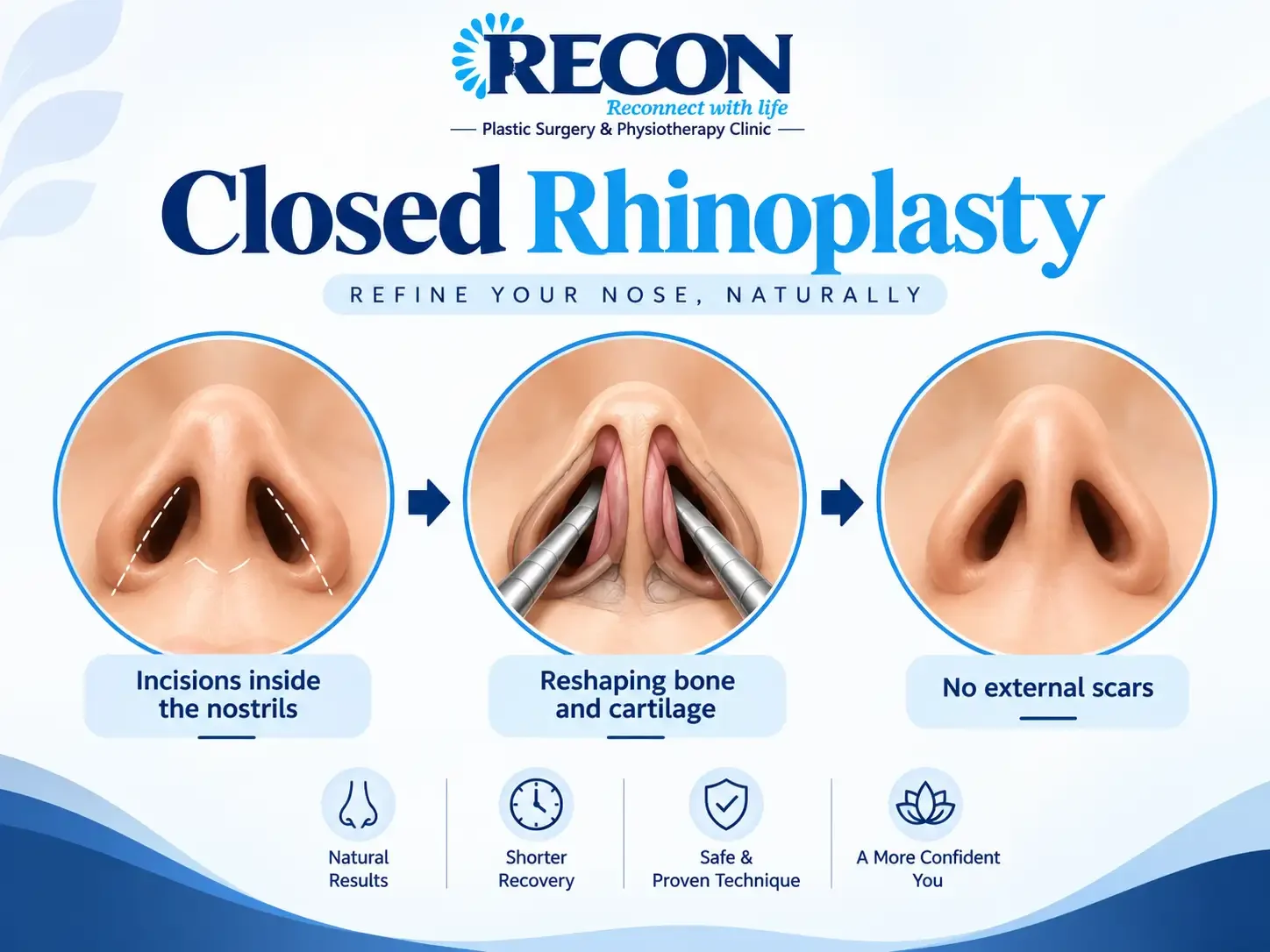 Infographic mentioning how closed rhinoplasty works.