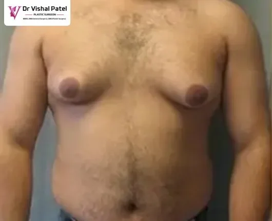 What is Grade 3 Gynecomastia