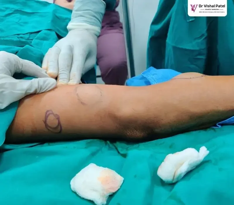 Multiple Lipoma in Mumbai on forearm. Marked with pen.