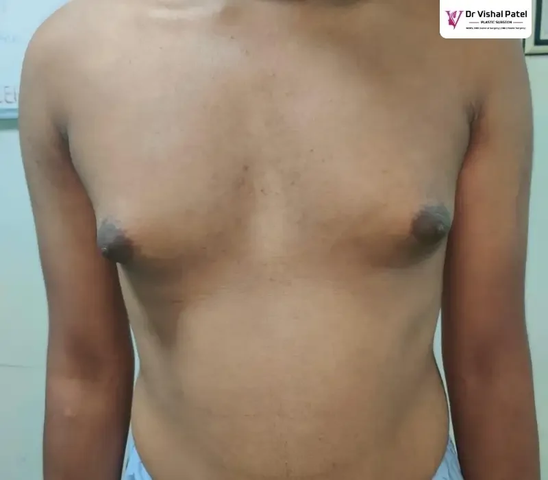 Man Chest with enlarged breast in Mumbai.