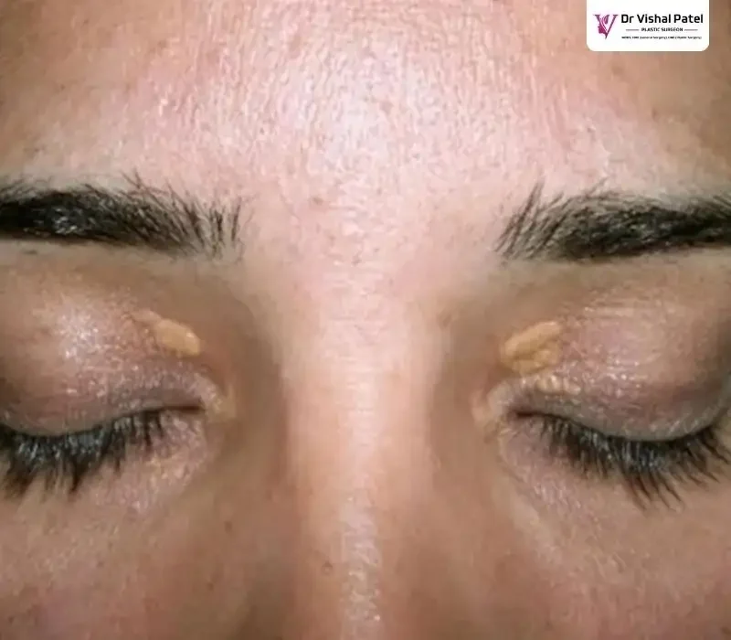 Cholesterol deposits on both eyelids.