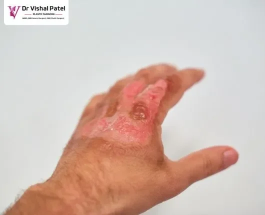 A Hand with Burns on fingers.