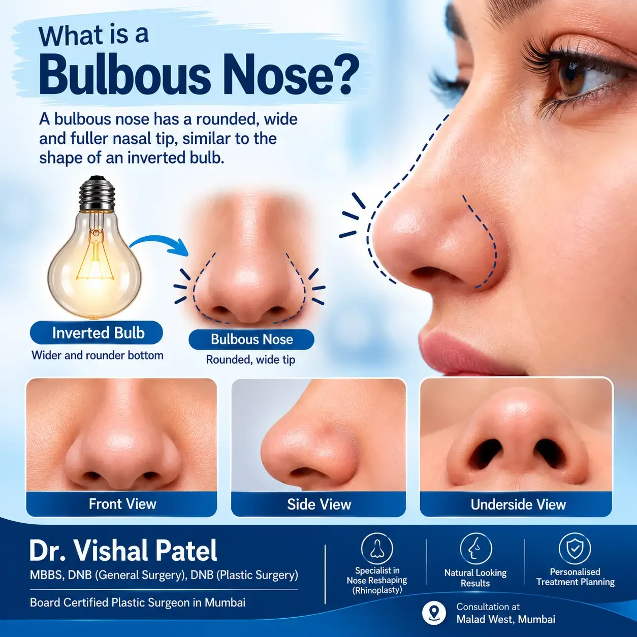 Pictorial representation of bulbouse nose structure.