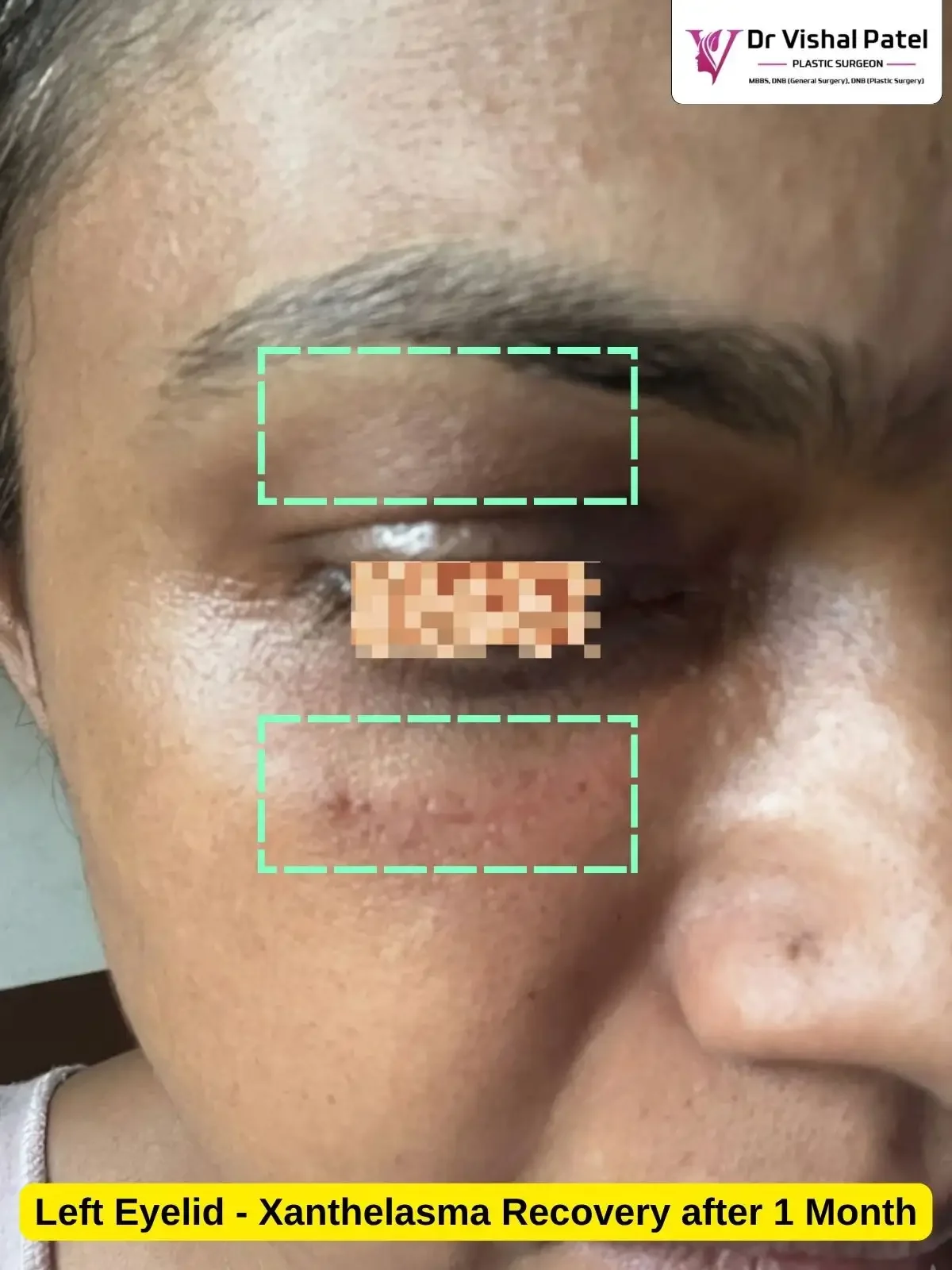 Xanthelasma 1 Month after Surgery photo - By Dr. Vishal Patel - Left Eyelid