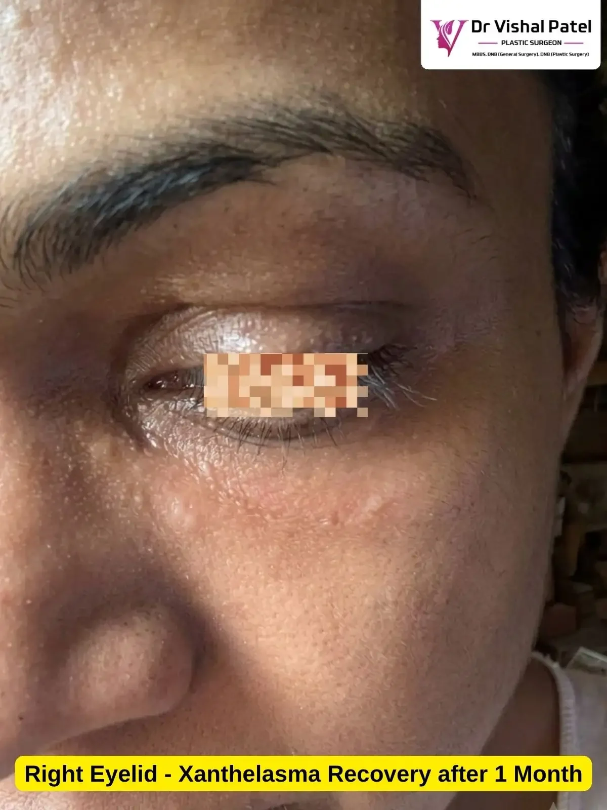 Xanthelasma 1 Month after Surgery photo - By Dr. Vishal Patel - Right Eyelid