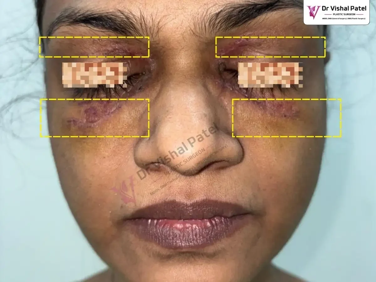 Xanthelasma Post Surgery Photo showing no patches around eyelids.