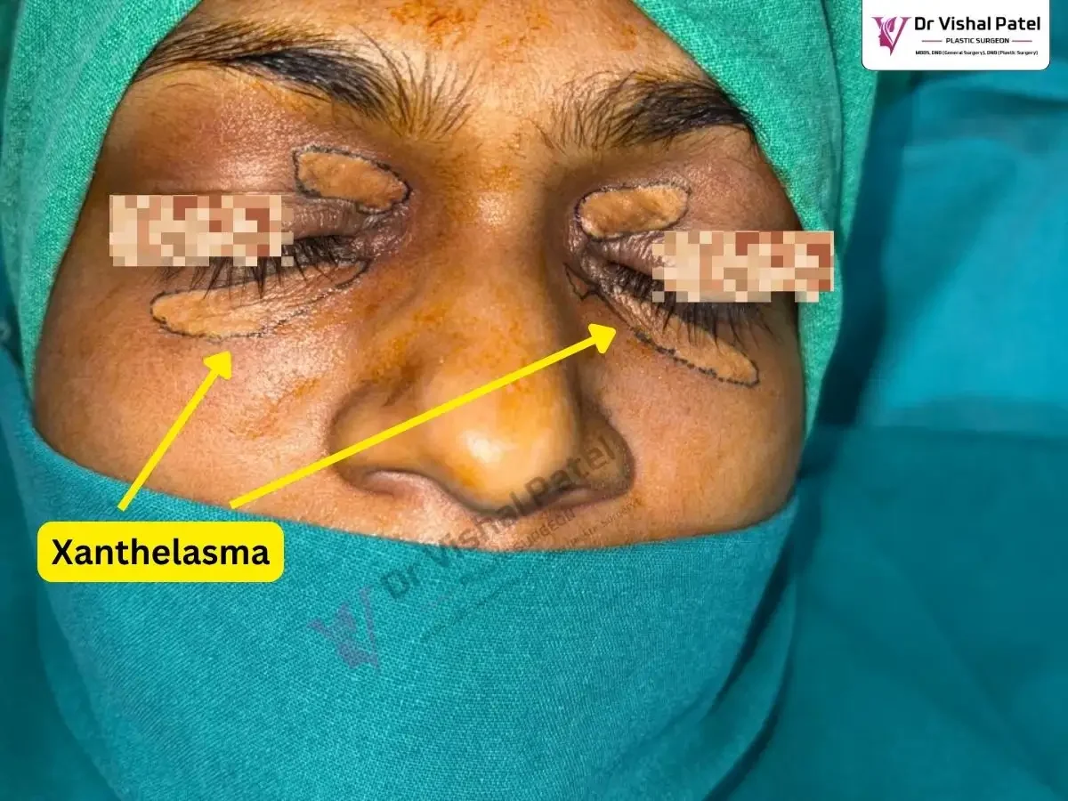 4 Xanthelasma Cholesterol Patches around eyelids.